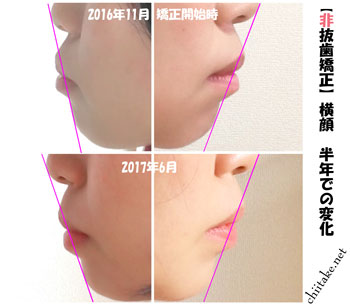 カリエールディスタライザーとゴムかけでの非抜歯矯正-横顔ビフォーアフター 201611-201706