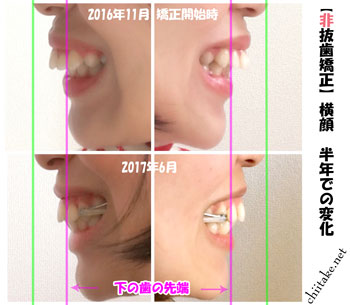 カリエールディスタライザーとゴムかけでの非抜歯矯正-横顔の出っ歯具合ビフォーアフター 201611-201706