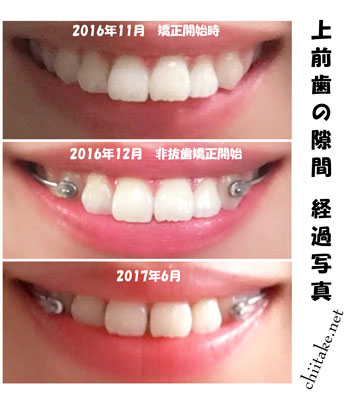 カリエールディスタライザーとゴムかけでの非抜歯矯正-上前歯の隙間の変化 1611-201706