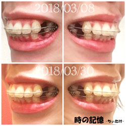 抜歯矯正-1ヵ月での歯の動き-犬歯の位置 201803