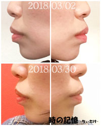 抜歯矯正-1ヵ月での歯の動き-横顔(Eライン) 201803