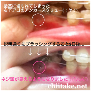 下顎に打った歯科矯正用アンカースクリューが歯茎に埋もれた、その後-02