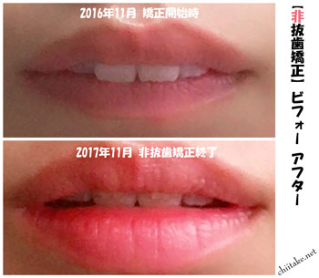 表側装置(セラミックブラケット)での非抜歯矯正ビフォーアフター-唇を閉じた状態 201611-201711