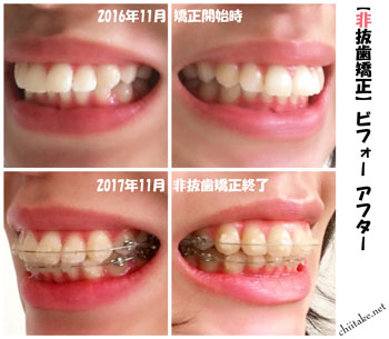 表側装置(セラミックブラケット)での非抜歯矯正ビフォーアフター-斜め 201611-201711