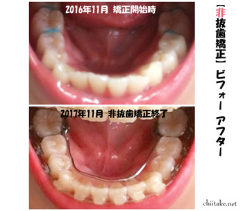 表側装置(セラミックブラケット)での非抜歯矯正ビフォーアフター-下の歯並び 201611-201711