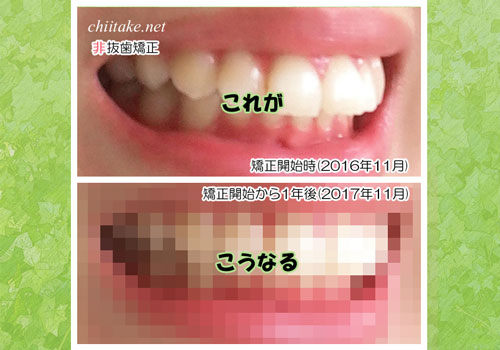非抜歯矯正ビフォーアフター 201611-201711