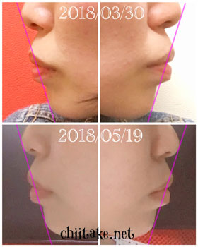 抜歯矯正-1ヵ月での歯の動き-横顔(Eライン) 201805