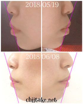 抜歯矯正-1ヵ月での歯の動き-横顔(Eライン) 201806