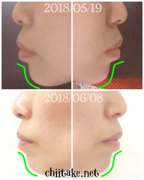 抜歯矯正-1ヵ月での歯の動き-横顔(顎の形) 201806-01