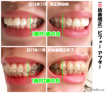 表側装置(セラミックブラケット)での非抜歯矯正ビフォーアフター-噛み合わせ 201611-201711