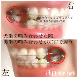 犬歯が噛み合わない 201806-02