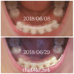 抜歯矯正-1ヵ月での歯の動き-上から見た下の歯 201806