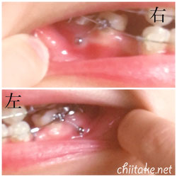 下顎左右のアンカースクリュー 201806