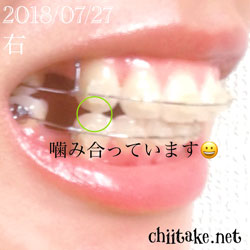 犬歯が噛み合うようになる 201807-01