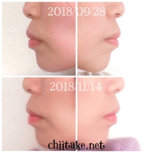 インプラント矯正-1ヵ月での歯の動き-横顔(Eライン) 201811