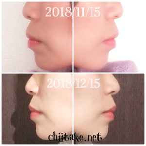 インプラント矯正-1ヵ月での歯の動き-横顔(Eライン) 201812