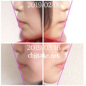 インプラント矯正-1ヵ月での歯の動き-横顔(Eライン) 201903