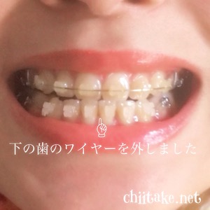 知覚過敏(?)で一時的にブラケットオフ 201903-05