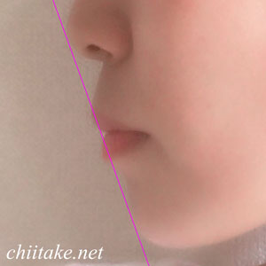 [抜歯矯正] 順調に進んでいます 201905