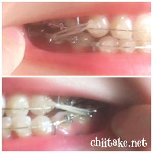 奥歯を手前に動かすためにゴムかけが復活 201906