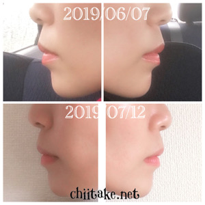 インプラント矯正-1ヵ月での歯の動き-横顔(Eライン) 201907