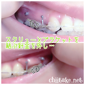 [歯列矯正]上の歯の位置調整 - 奥歯を手前に動かす、その1 201907