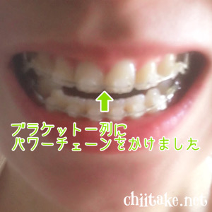[歯列矯正]上の歯の位置調整 - パワーチェーンを一列に着ける 201907