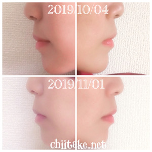 インプラント矯正-1ヵ月での歯の動き-横顔(Eライン) 201911