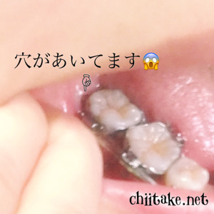 33歳で横向き埋没の親不知が生えてきました